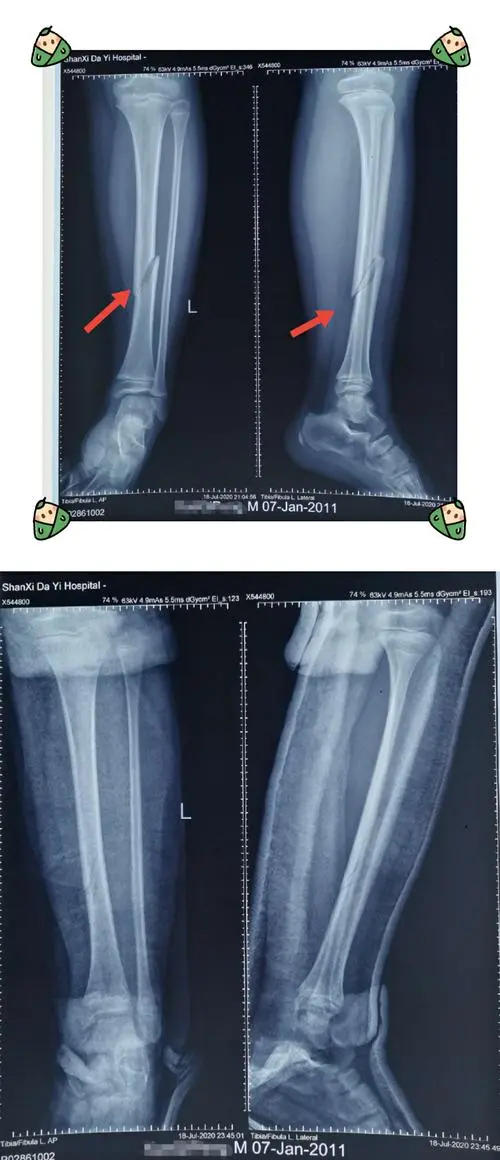 左小腿胫腓骨骨折图片 小腿胫腓骨骨折图片 伤感说说吧